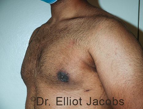 Male breast, after Gynecomastia treatment, l-side oblique view - patient 115