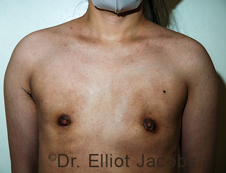 Gynecomastia. Male breast, after FTM Top Surgery treatment, front view, patient 36