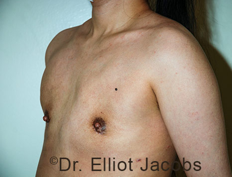 Gynecomastia. Male breast, after FTM Top Surgery treatment, l-side oblique view, patient 36