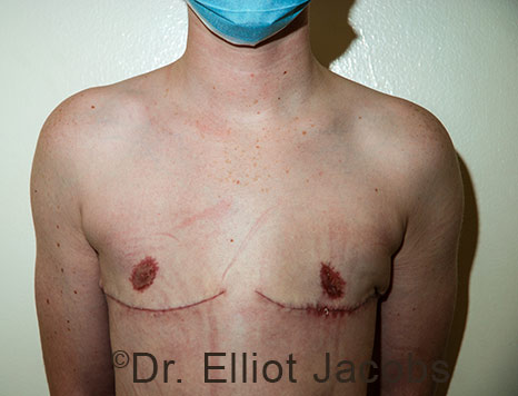 Gynecomastia. Male breast, after FTM Top Surgery treatment, front view, patient 37