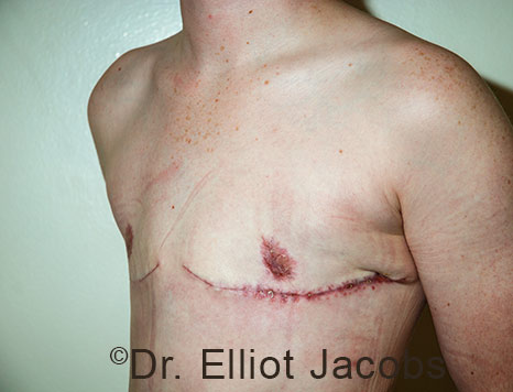 Gynecomastia. Male breast, after FTM Top Surgery treatment, l-side oblique view, patient 37