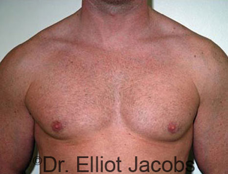 Male breast, after Gynecomastia treatment, front view, patient 34