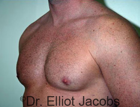 Male breast, after Gynecomastia treatment, l-side oblique view - patient 34