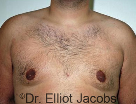 Male breast, after Gynecomastia treatment, front view, patient 35