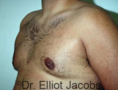 Male breast, after Gynecomastia treatment, l-side oblique view - patient 35