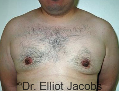 Male breast, after Gynecomastia treatment, front view, patient 36