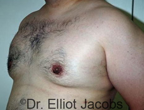 Male breast, after Gynecomastia treatment, l-side oblique view - patient 36