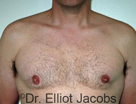 Male breast, after Gynecomastia treatment, front view, patient 37