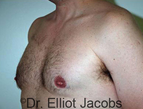 Male breast, after Gynecomastia treatment, l-side oblique view - patient 37