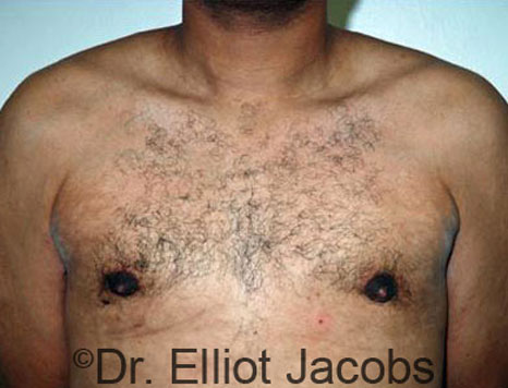 Male breast, after Gynecomastia treatment, front view, patient 38