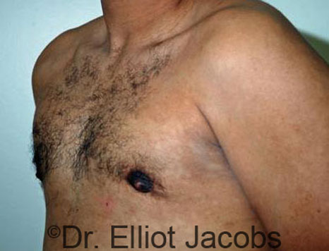 Male breast, after Gynecomastia treatment, l-side oblique view - patient 38