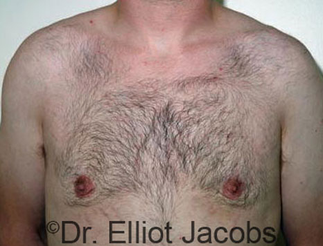 Male breast, after Gynecomastia treatment, front view, patient 39