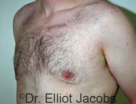 Male breast, after Gynecomastia treatment, l-side oblique view - patient 39