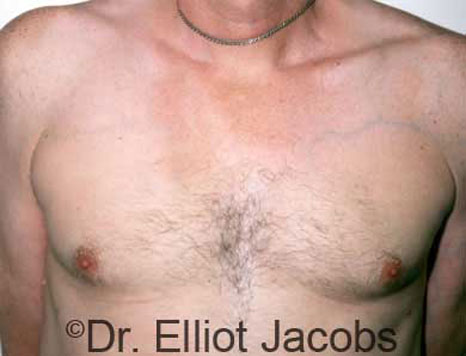 Male breast, after Treatment of Male Chest Asymmetry, front view, patient 3