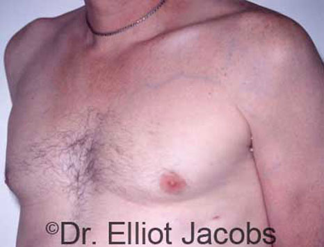 Male breast, after Gynecomastia treatment, l-side oblique view, patient 4