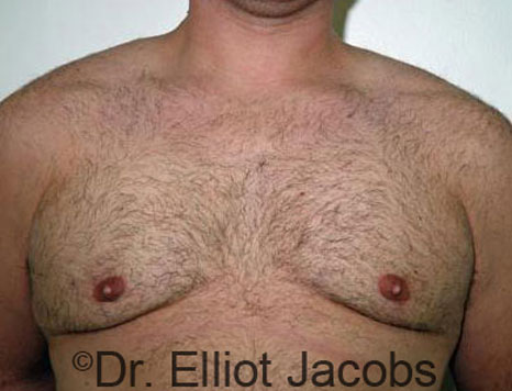 Male breast, after Gynecomastia treatment, front view, patient 40