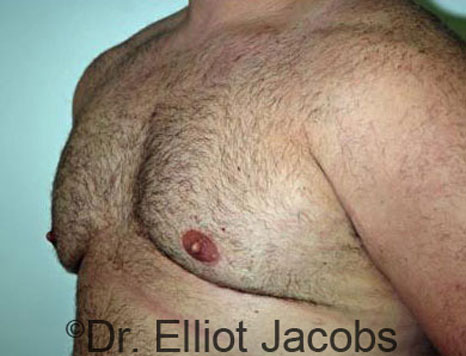 Male breast, after Gynecomastia treatment, l-side oblique view - patient 40