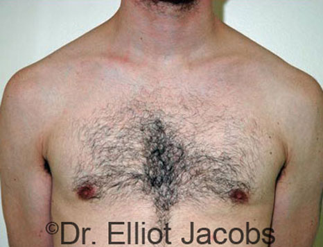 Male breast, after Gynecomastia treatment, front view, patient 41
