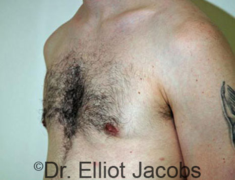 Male breast, after Gynecomastia treatment, l-side oblique view - patient 41