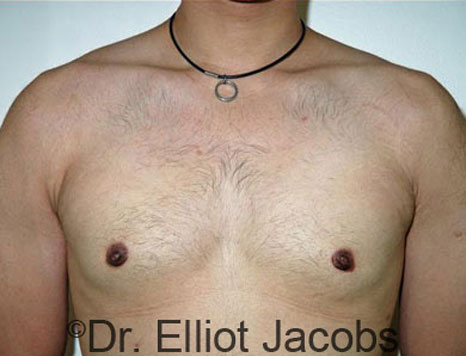 Male breast, after Gynecomastia treatment, front view, patient 42