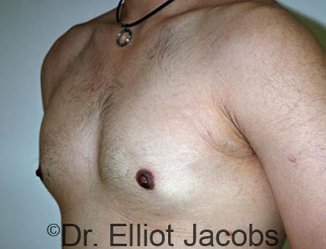 Male breast, after Gynecomastia treatment, l-side oblique view - patient 42