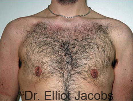 Male breast, after Gynecomastia treatment, front view, patient 43