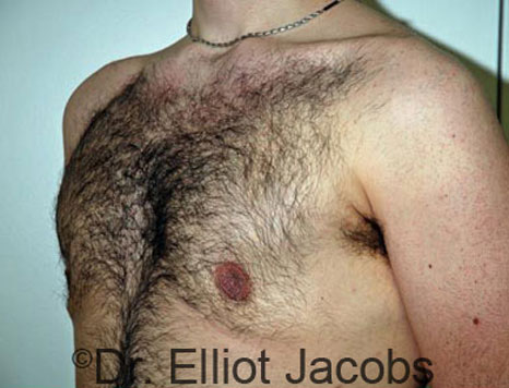 Male breast, after Gynecomastia treatment, l-side oblique view - patient 43