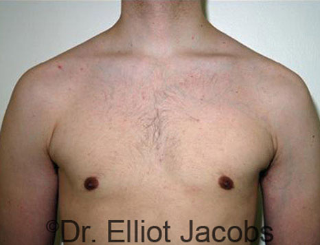 Male breast, after Gynecomastia treatment, front view, patient 44