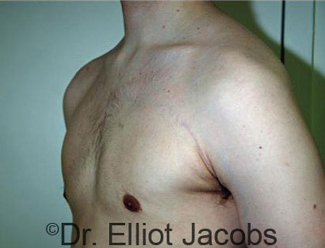 Male breast, after Gynecomastia treatment, l-side oblique view - patient 44