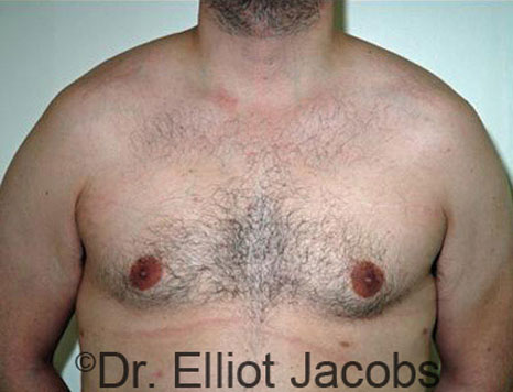 Male breast, after Gynecomastia treatment, front view, patient 45