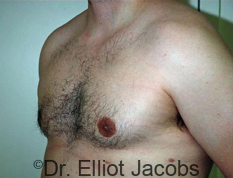 Male breast, after Gynecomastia treatment, l-side oblique view - patient 45