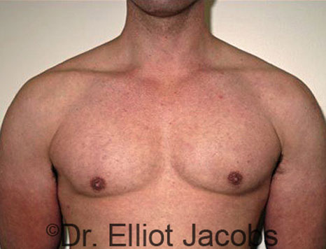 Male breast, after Gynecomastia treatment, front view, patient 46