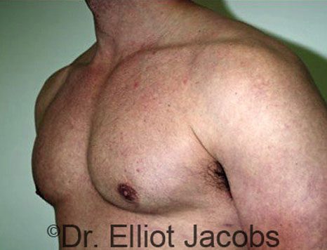 Male breast, after Gynecomastia treatment, l-side oblique view - patient 46