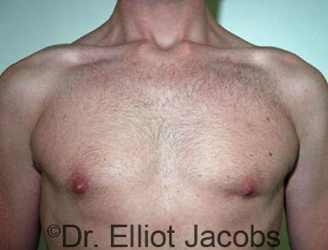 Male breast, after Gynecomastia treatment, front view, patient 47