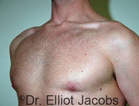 Male breast, after Gynecomastia treatment, l-side oblique view - patient 47