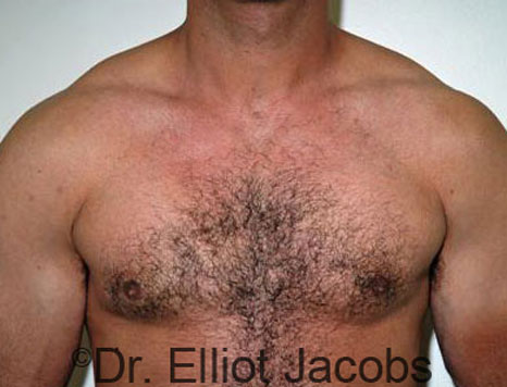 Male breast, after Gynecomastia treatment, front view, patient 48