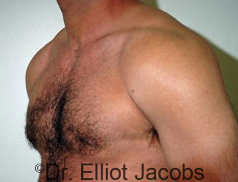 Male breast, after Gynecomastia treatment, l-side oblique view - patient 48