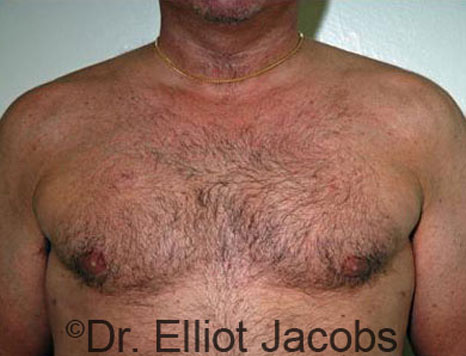 Male breast, after Gynecomastia treatment, front view, patient 49