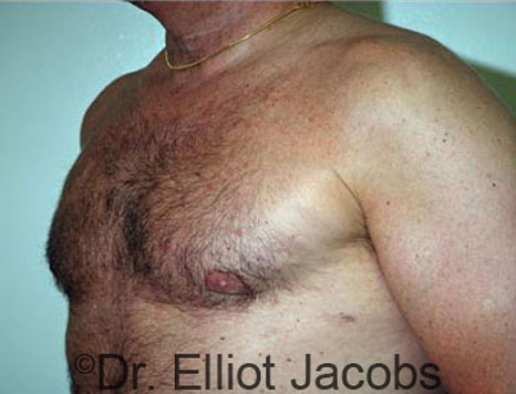 Male breast, after Gynecomastia treatment, l-side oblique view - patient 49