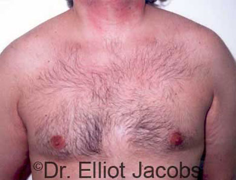Male breast, after Gynecomastia treatment, front view, patient 5