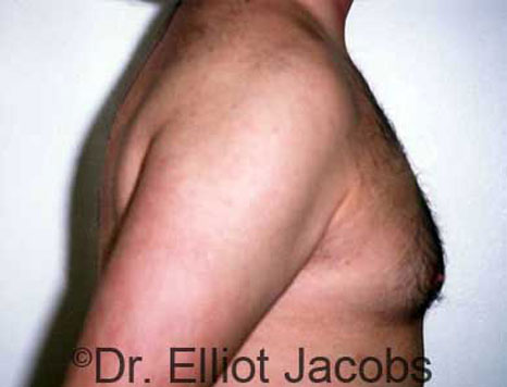Male breast, after Gynecomastia treatment, r-side view, patient 5