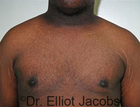 Male breast, after Gynecomastia treatment, front view, patient 50