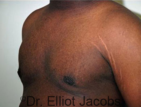 Male breast, after Gynecomastia treatment, l-side oblique view - patient 50