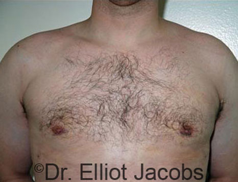 Male breast, after Gynecomastia treatment, front view, patient 51