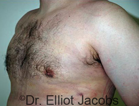 Male breast, after Gynecomastia treatment, l-side oblique view - patient 51