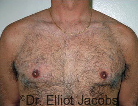 Male breast, after Gynecomastia treatment, front view, patient 52