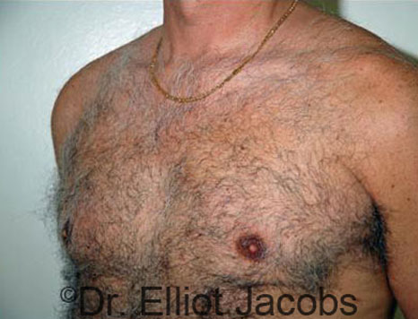 Male breast, after Gynecomastia treatment, l-side oblique view - patient 52