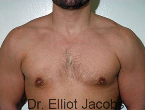 Male breast, after Gynecomastia treatment, front view, patient 53