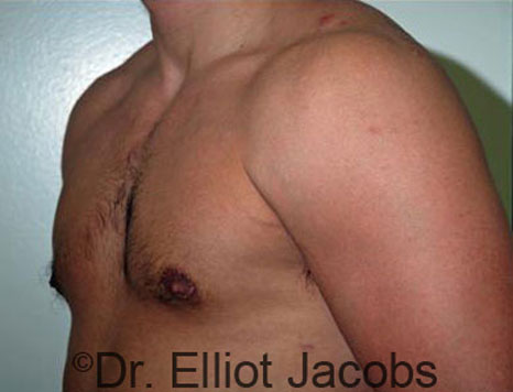 Male breast, after Gynecomastia treatment, l-side oblique view - patient 53