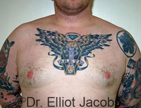 Male breast, after Gynecomastia treatment, front view, patient 54